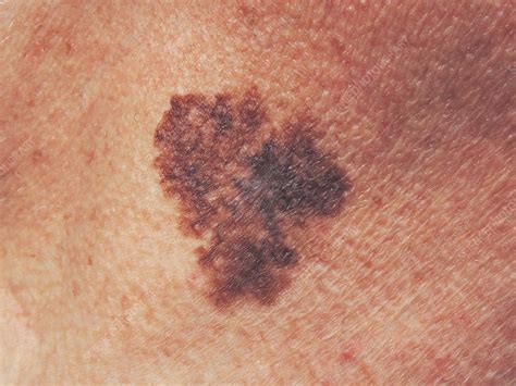 melanoma in situ lentigo maligna type icd 10